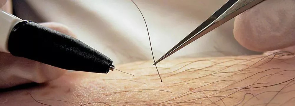 Nadelepilation, Elektroepilation, permanente Haarentfernung Transgender