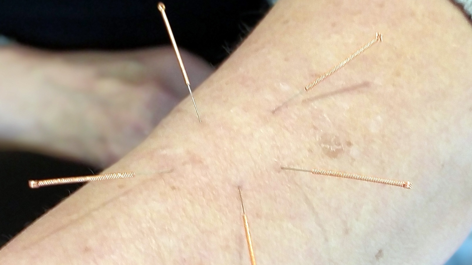 Akupunktur wird eingesezt bei Rückenschmerzen, Kopfschmerzen, Migräne, Arthrose, Stress und Angst, Schlafstörungen, Schlaflosigkeit, Schlafprobleme, Verdauungsstörungen, Reizdarmsyndrom, Verdauungsbeschwerden, Allergien, Menstruationsbeschwerden, Wechseljahresbeschwerden, Unfruchtbarkeit, Asthma, Ekzeme, Psoriasis, Akne