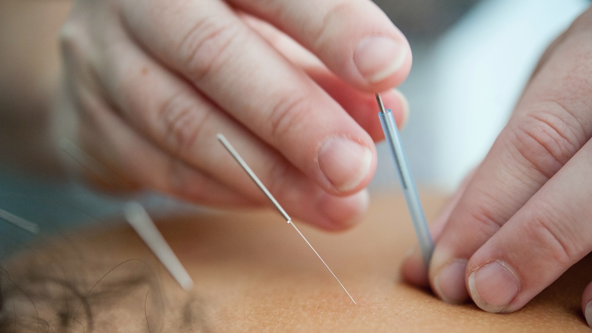 Akupunktur wird eingesezt bei Rückenschmerzen, Kopfschmerzen, Migräne, Arthrose, Stress und Angst, Schlafstörungen, Schlaflosigkeit, Schlafprobleme, Verdauungsstörungen, Reizdarmsyndrom, Verdauungsbeschwerden, Allergien, Menstruationsbeschwerden, Wechseljahresbeschwerden, Unfruchtbarkeit, Asthma, Ekzeme, Psoriasis, Akne