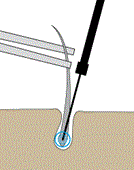 Elektroepilation, Nadelepilation, permanente Haarentfernung
