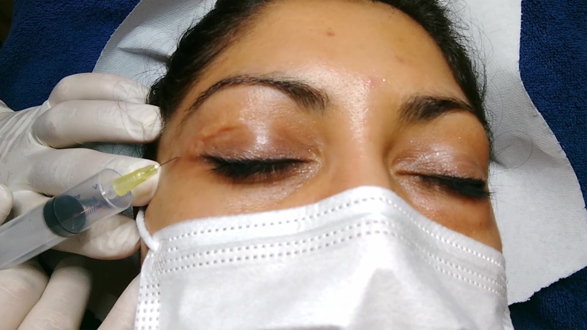 Anti-Aging / Faltenunterspritzung -> Carboxytherapie (CO²) als Facelift, bei Narben, Dehnungsstreifen, Rosazea, Besenreisern, Schmerztherapie